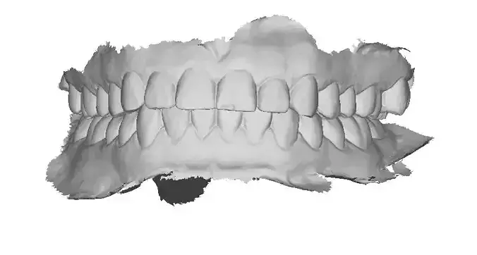 P007 - Dental - Intraoral Scan STL-PLY-OBJ