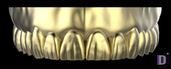 The complete set of 36 Expression dental libraries - Exocad Low-poly 3D model_54