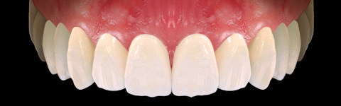 The complete set of 36 Expression dental libraries - Exocad Low-poly 3D model_56