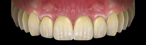 The complete set of 36 Expression dental libraries - Exocad Low-poly 3D model_20