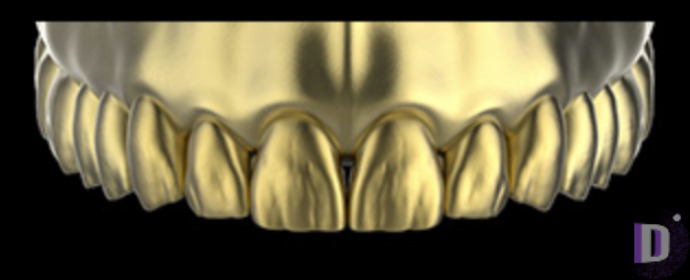 The complete set of 36 Expression dental libraries - Exocad Low-poly 3D model_39