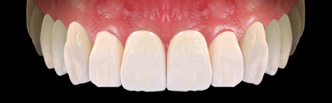 The complete set of 36 Expression dental libraries - Exocad Low-poly 3D model_4
