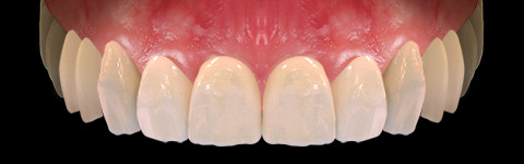 The complete set of 36 Expression dental libraries - Exocad Low-poly 3D model_14