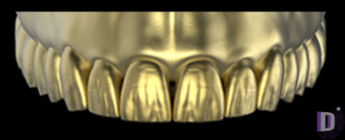 The complete set of 36 Expression dental libraries - Exocad Low-poly 3D model_30