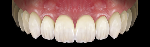 The complete set of 36 Expression dental libraries - Exocad Low-poly 3D model_15