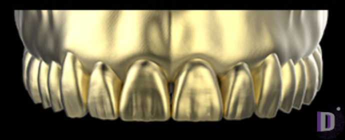 The complete set of 36 Expression dental libraries - Exocad Low-poly 3D model_60