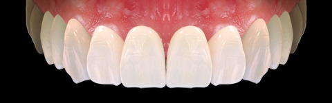 The complete set of 36 Expression dental libraries - Exocad Low-poly 3D model_51