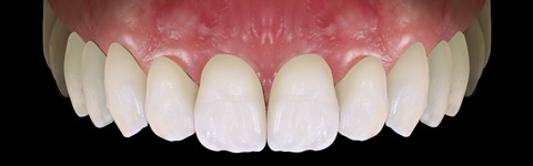 The complete set of 36 Expression dental libraries - Exocad Low-poly 3D model_34
