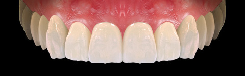 The complete set of 36 Expression dental libraries - Exocad Low-poly 3D model_6