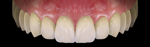 The complete set of 36 Expression dental libraries - Exocad Low-poly 3D model_37