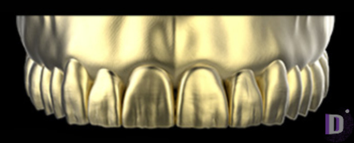 The complete set of 36 Expression dental libraries - Exocad Low-poly 3D model_7