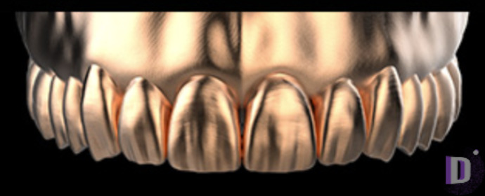 The complete set of 36 Expression dental libraries - Exocad Low-poly 3D model_11