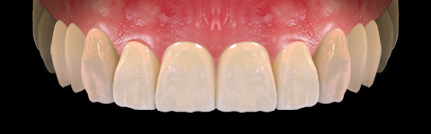 The complete set of 36 Expression dental libraries - Exocad Low-poly 3D model_8