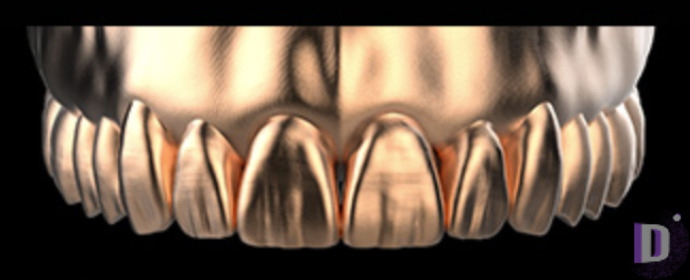 The complete set of 36 Expression dental libraries - Exocad Low-poly 3D model_59