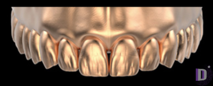 The complete set of 36 Expression dental libraries - Exocad Low-poly 3D model_36