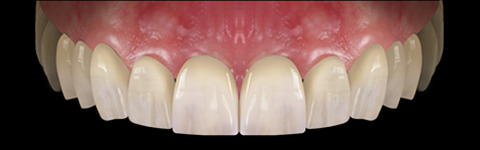 The complete set of 36 Expression dental libraries - Exocad Low-poly 3D model_29