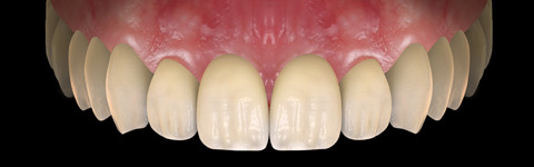 The complete set of 36 Expression dental libraries - Exocad Low-poly 3D model_18