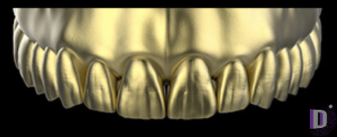 The complete set of 36 Expression dental libraries - Exocad Low-poly 3D model_48