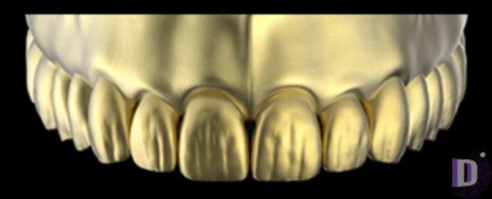 The complete set of 36 Expression dental libraries - Exocad Low-poly 3D model_22