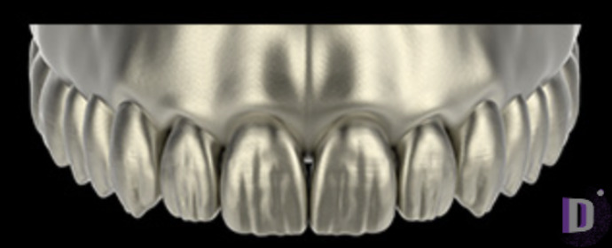 The complete set of 36 Expression dental libraries - Exocad Low-poly 3D model_16