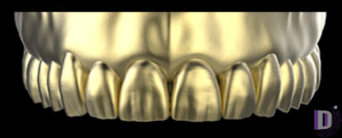 The complete set of 36 Expression dental libraries - Exocad Low-poly 3D model_13