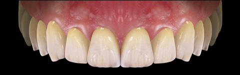 The complete set of 36 Expression dental libraries - Exocad Low-poly 3D model_47