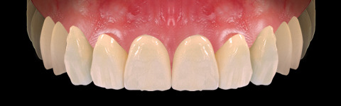 The complete set of 36 Expression dental libraries - Exocad Low-poly 3D model_61