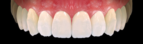 The complete set of 36 Expression dental libraries - Exocad Low-poly 3D model_9