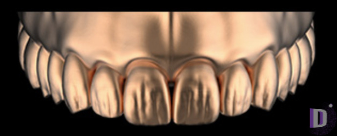 The complete set of 36 Expression dental libraries - Exocad Low-poly 3D model_19