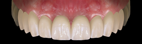The complete set of 36 Expression dental libraries - Exocad Low-poly 3D model_28