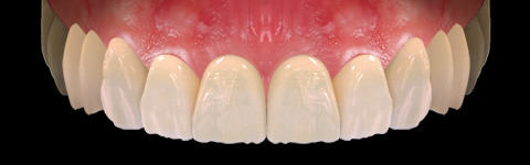 The complete set of 36 Expression dental libraries - Exocad Low-poly 3D model_55
