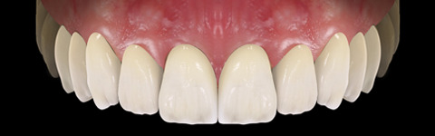 The complete set of 36 Expression dental libraries - Exocad Low-poly 3D model_41