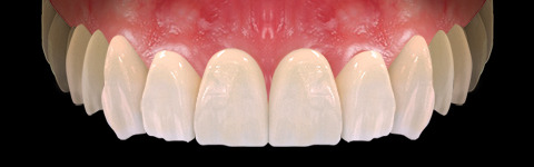 The complete set of 36 Expression dental libraries - Exocad Low-poly 3D model_53
