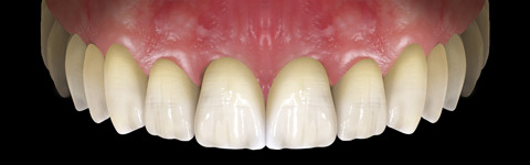The complete set of 36 Expression dental libraries - Exocad Low-poly 3D model_46