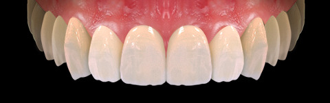 The complete set of 36 Expression dental libraries - Exocad Low-poly 3D model_12