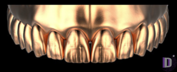 The complete set of 36 Expression dental libraries - Exocad Low-poly 3D model_45