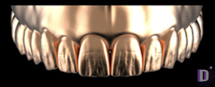 The complete set of 36 Expression dental libraries - Exocad Low-poly 3D model_27
