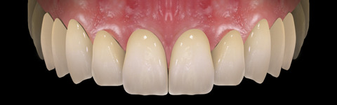 The complete set of 36 Expression dental libraries - Exocad Low-poly 3D model_40