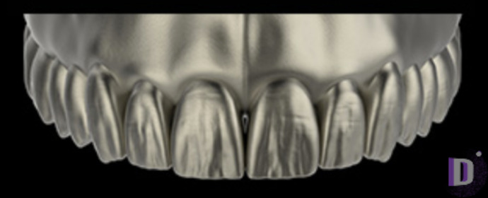 The complete set of 36 Expression dental libraries - Exocad Low-poly 3D model_25