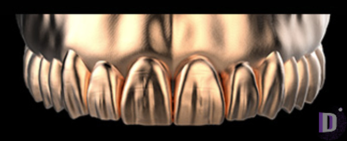 The complete set of 36 Expression dental libraries - Exocad Low-poly 3D model_52
