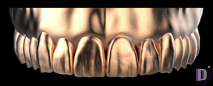 The complete set of 36 Expression dental libraries - Exocad Low-poly 3D model_5