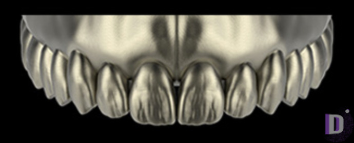 The complete set of 36 Expression dental libraries - Exocad Low-poly 3D model_33