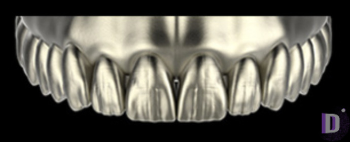 The complete set of 36 Expression dental libraries - Exocad Low-poly 3D model_43