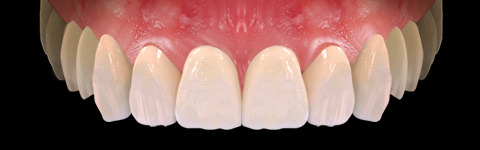 The complete set of 36 Expression dental libraries - Exocad Low-poly 3D model_58