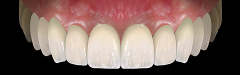 The complete set of 36 Expression dental libraries - Exocad Low-poly 3D model_24