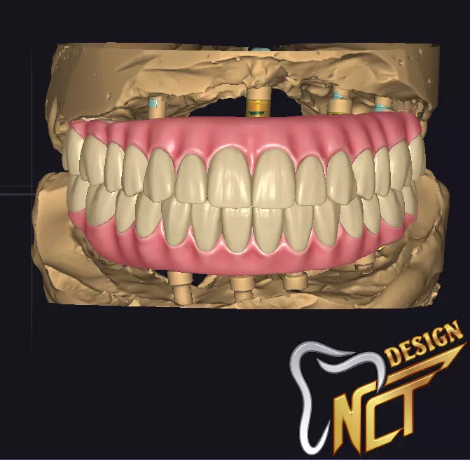 Dental Crown - Teeth upper and lower Low-poly 3D model_0