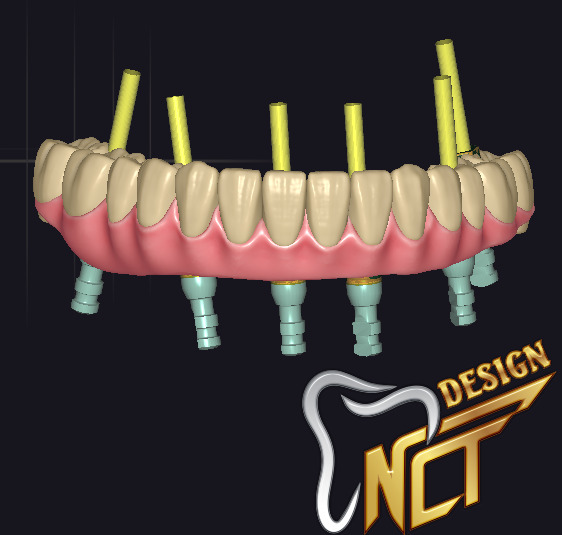Dental Crown - Teeth upper and lower Low-poly 3D model_3