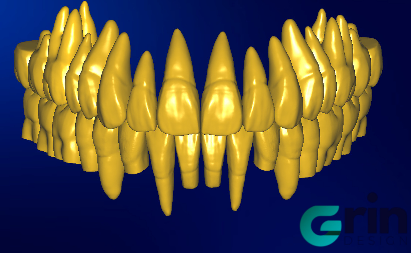 The complete set of - 34 Grin Design dental libraries - Exocad Low-poly 3D model_17