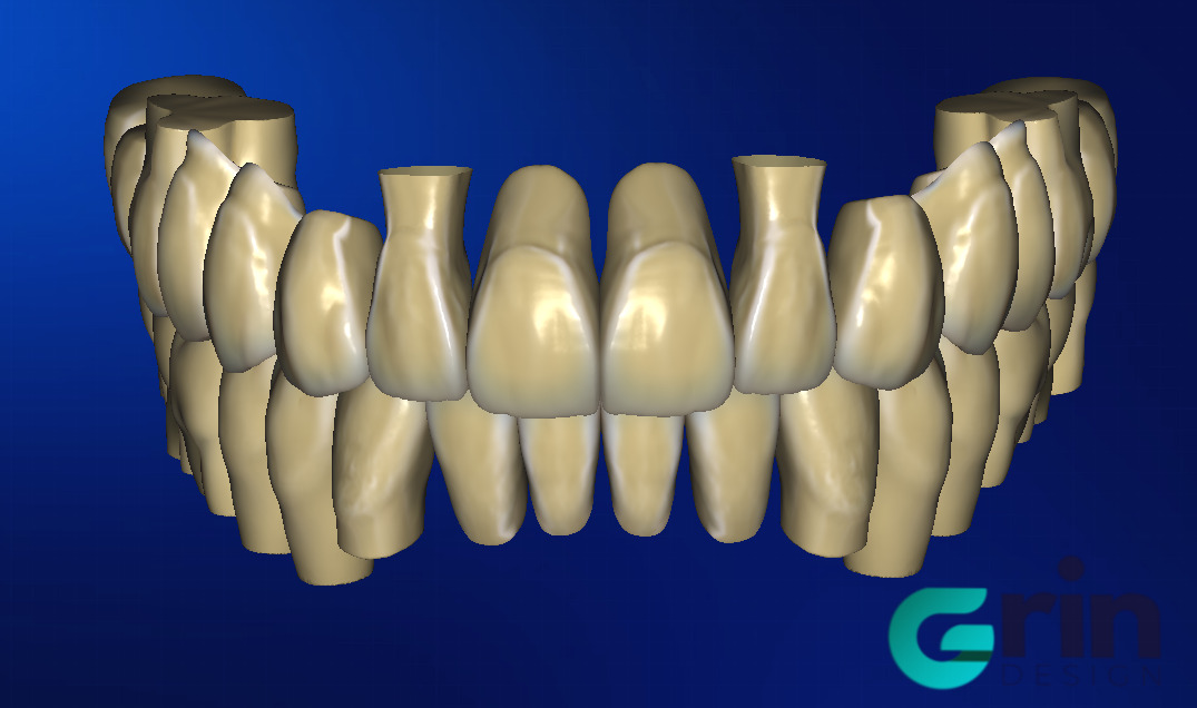 The complete set of - 34 Grin Design dental libraries - Exocad Low-poly 3D model_8