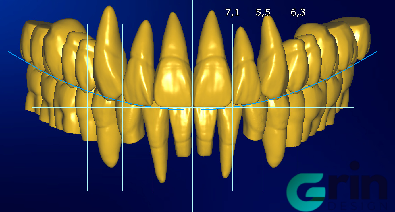 The complete set of - 34 Grin Design dental libraries - Exocad Low-poly 3D model_16